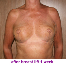plastic-surgery-breast-lift